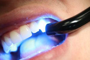 concerned-about-bpa-in-dental-fillings?-what-you-need-to-know-–-dr.-judson-wall